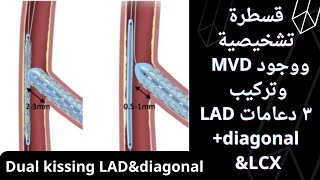 قسطرة تشخيصية وتبين MVD  وتم تركيب ٣ دعامات LAD+diagonal  bifurcation  & LCX