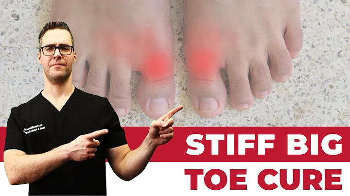 Stiff Big Toe Joint Arthritis Cure [Hallux Rigidus Treatment 2024!]