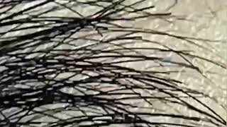 Blackhead Removal: Satisfying Routine - blackheads lips , Nose - ingrown hair removal   2025