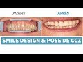 CAS CLINIQUE : SMILE DESIGN & POSE DE COURONNES CERAMO ZIRCONE