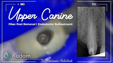 Fiber Post Removal | Nonsurgical Endodontic Retreatment