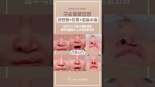 #구순구개열 명의의 코변형+인중+입술 수술 전후사진 #shorts