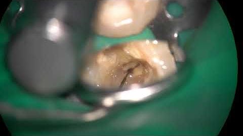 ledge canal bypassed and prepared with TCA technique using HyFlex EDM