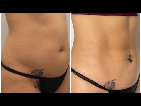 Maintaining Your Body Contouring Results: Tips for Long-Term Success