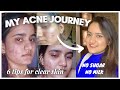 How i cleared my skin acne journey  6 tips changed my life