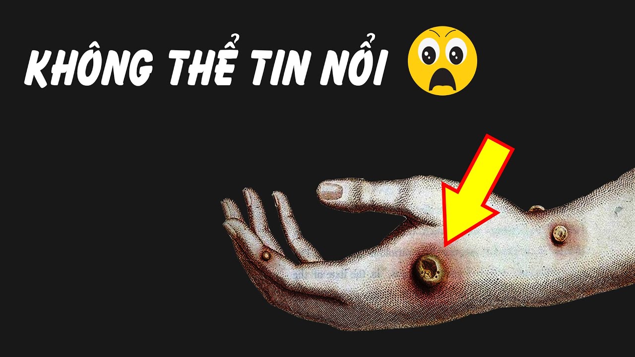 Những ca xóa xăm vừa đau đớn vừa hỏng da vĩnh viễn  2sao