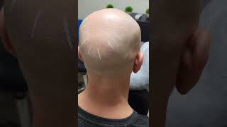 Scalp Micropigmentation In Kent, SMP, Scalp Tattoo, Hair Tattoo, Men's Hair Loss Solution In Kent.