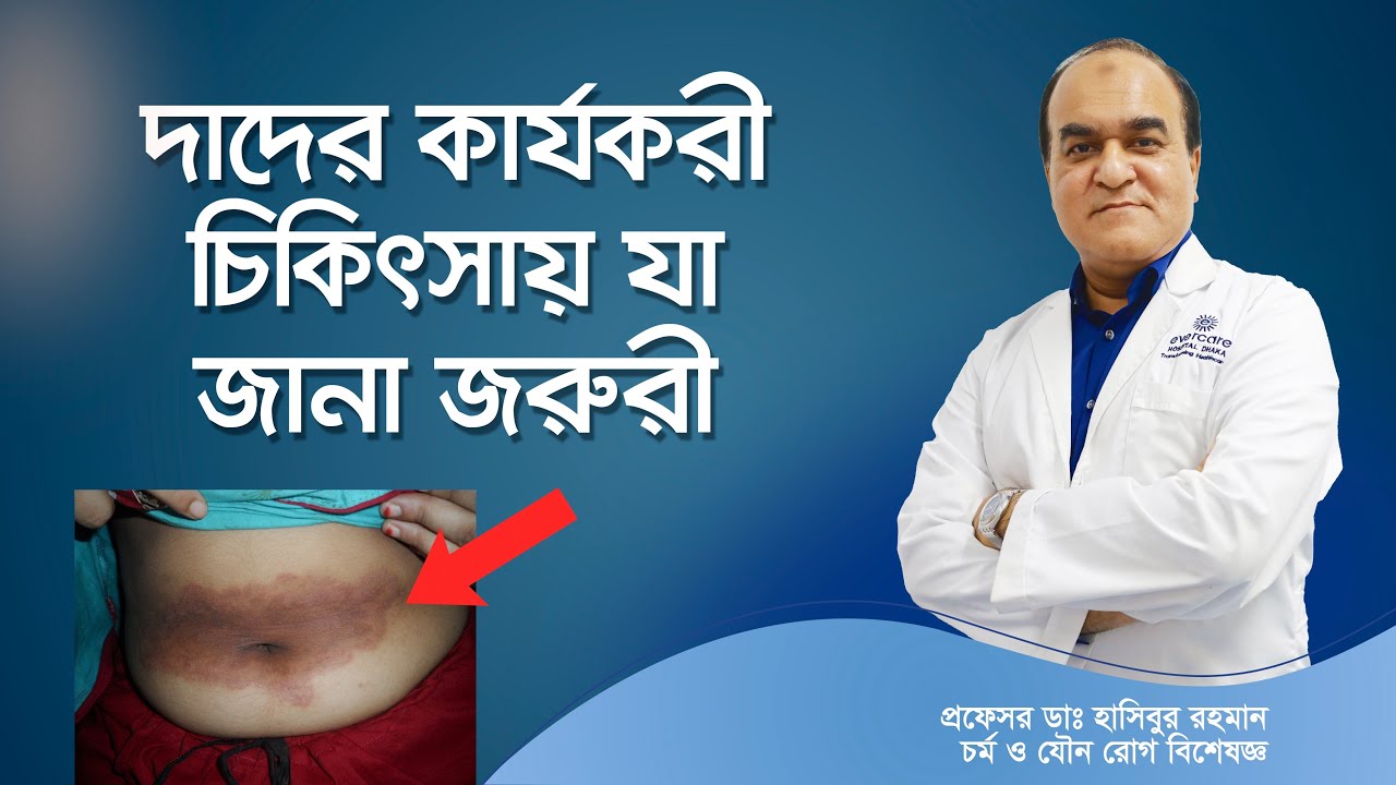 দাউদের কার্যকরী চিকিৎসায় যা জানা জরুরী। Ringworm: Symptoms, Pictures, Treatment, Diagnosis & More
