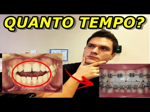 QUANTO TEMPO DEMORA PARA CORRIGIR A MORDIDA ABERTA COM APARELHO ORTÔNTICO?