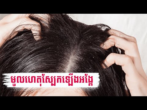 មូលហេតុដែលបណ្តាលឱ្យស្បែកក្បាលឡើងអង្គែ​