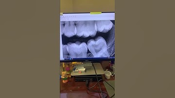 NanoPix by Eighteeth is an excellent sensor. #dentists #dentalartistry #dentaltreatment #hygienist