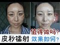 PicoSure Laser Review + Before&After|皮秒镭射体验＋前后对比[MsLindaY]