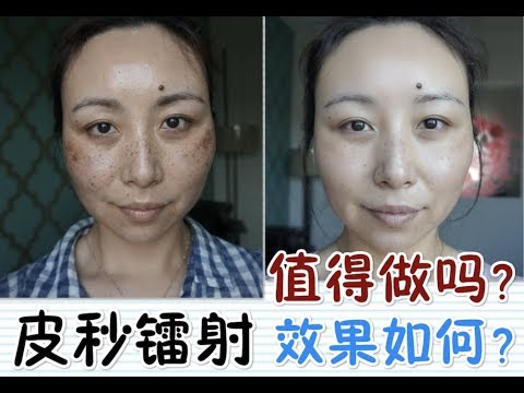 PicoSure Laser Review + Before&After|皮秒镭射体验＋前后对比[MsLindaY]