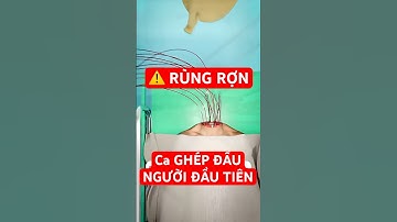 🤔 CA GHÉP ĐẦU NGƯỜI đầu tiên đã diễn ra như nào? #bacsicanhbao  #viral