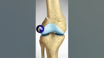 See how a Supracondylar Fracture of the Knee and Surgical Fixation works in 3D Animation.