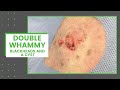 Double Whammy- Blackheads and a Cyst | Dr. Derm