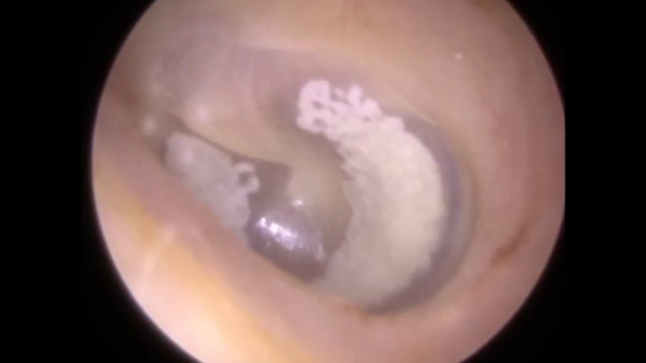 Tympanosclerotic Eardrum revealed post Ear Wax Removal - Mr Neel