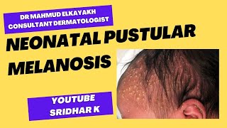 Neonatal pustular melanosis-a dermatologist's perspective #rash #newbornrash #pustularmelanosis