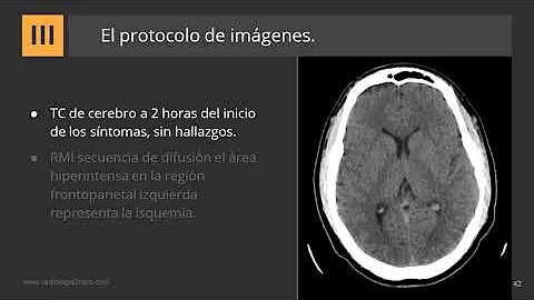 Come capire se si ha avuto un'ischemia?