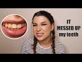 TEETH WHITENING FAIL || Spotlight Teeth White Strips sucks