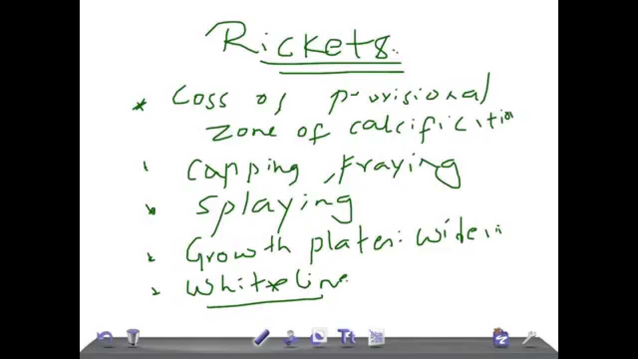 Signs of rickets Signs of rickets