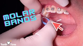 What are molar bands for? Getting RPE + Tongue Crib off - Tooth Time Family Dentistry New Braunfels