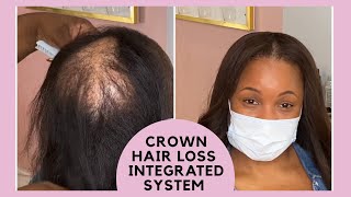 System for crown HAIR LOSS *no wig *no braided weave