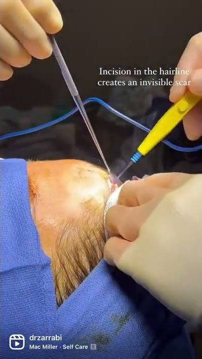 Osteoma Removal | Dr. Zarrabi #shorts