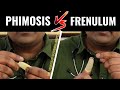 Ling ki Tight Chamdi or Seal | Phimosis vs Tight Frenulum (Hindi)