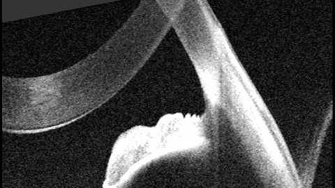 Topcon Swept Source chamber angle