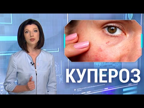 Что такое купероз? Причины появления, симптомы и лечение капиллярной сетки на лице. Формула здоровья