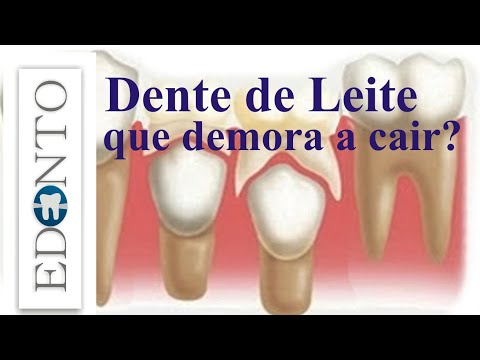 Dente de leite que demora a cair