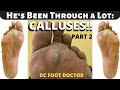 He's Been Through a Lot: The Calluses (Part 2)