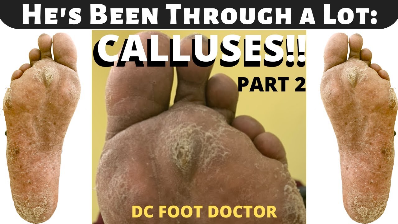 This Foot Callus Removal  Channel Is Equally Disgusting and  Satisfying to Watch