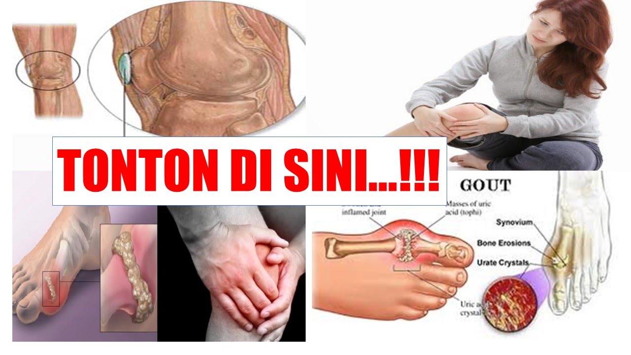 Obat Asam Urat Cepat Sembuh Penyembuhan Penyakit Asam Urat yang Cepat