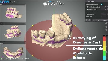 Digital Surveying of RPD / Delineamento Digital de PPR