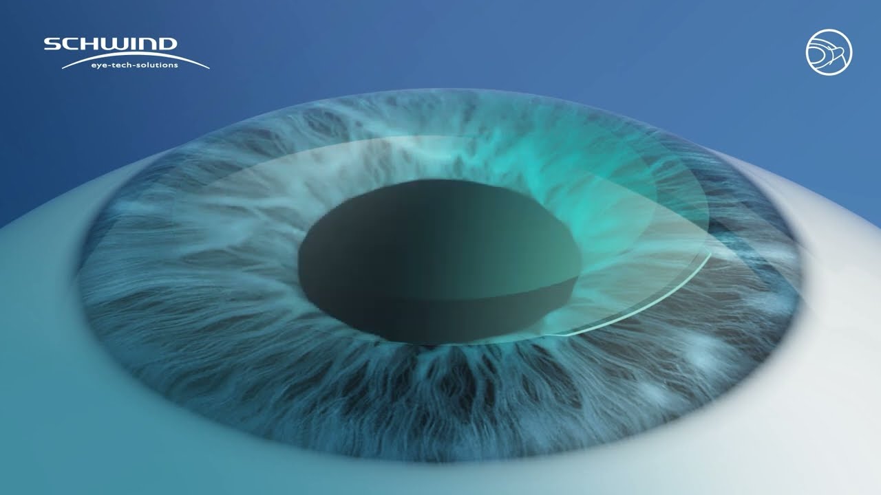 Metode laserskog skidanja dioptrije u Klinici Svjetlost