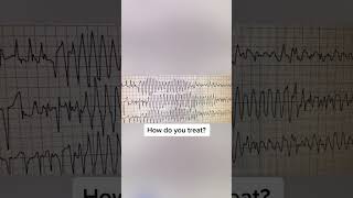 What’s the rhythm? #ekg #quiz