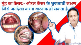 मुंह के कैंसर की पहचान व इलाज | signs of oral cancer | Mouth cancer symptoms in Hindi |@dramitkdubey