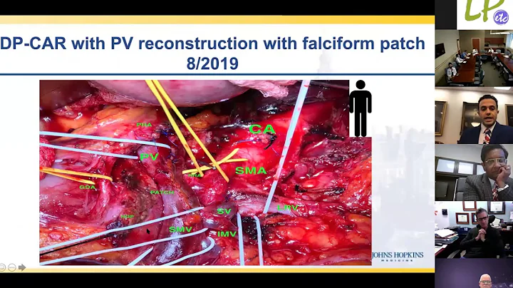Locally Advanced Pancreas Cancer; Management and Operative Techniques
