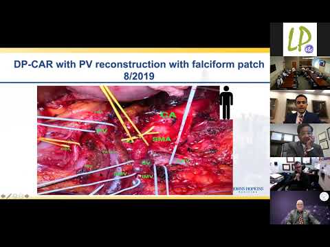 Locally Advanced Pancreas Cancer; Management and Operative Techniques