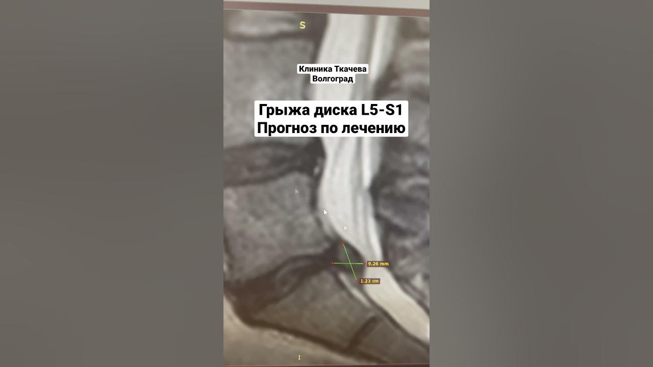 Грыжа диска l5 s1 что это