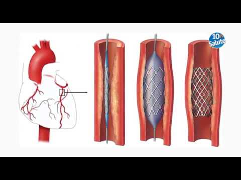 Come avviene un infarto e quanto tempo abbiamo per intervenire prima di avere conseguenze gravi?