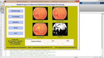 Glaucoma Detection using matlab