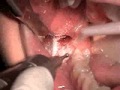 Removal of an impacted wisdom toothvertical impaction