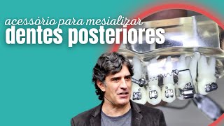 Acessório para mesializar dentes posteriores!