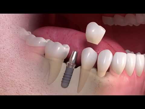 Video: Varpos Implantas: Procedūra, Veiksmingumas, Atkūrimas Ir Dar Daugiau