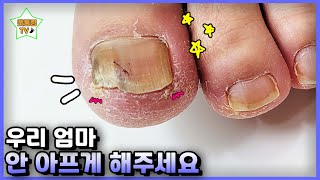 eng관리받고 나니깐 하나도 안 아프구먼!｜레푸스 서면점/사상점｜내성발톱｜문제성발톱｜ingrown toenail｜Athlete&#39;s foot-Fresh Foot