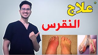 علاج النقرس وكيفية الحماية من أعراضه - Gout