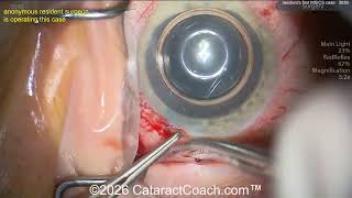 CataractCoach™ 3036: resident surgeon's first MSICS case